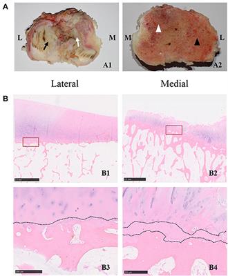 Potential Value of Matrix Metalloproteinase-13 as a Biomarker for Osteoarthritis